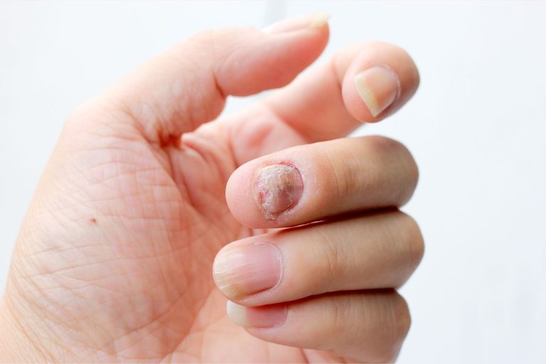 Mycose des ongles
