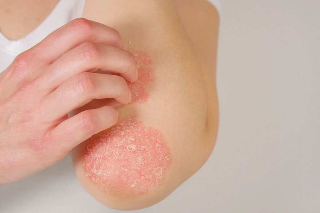 Psoriasis