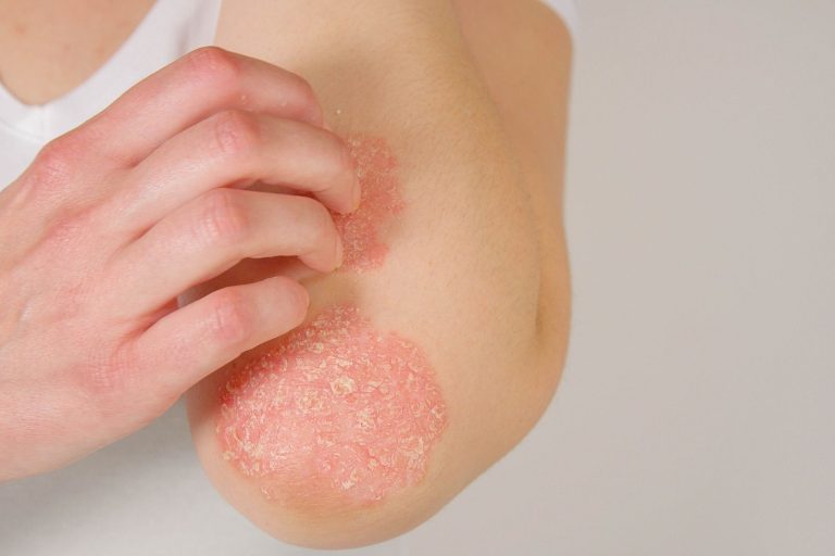 Psoriasis