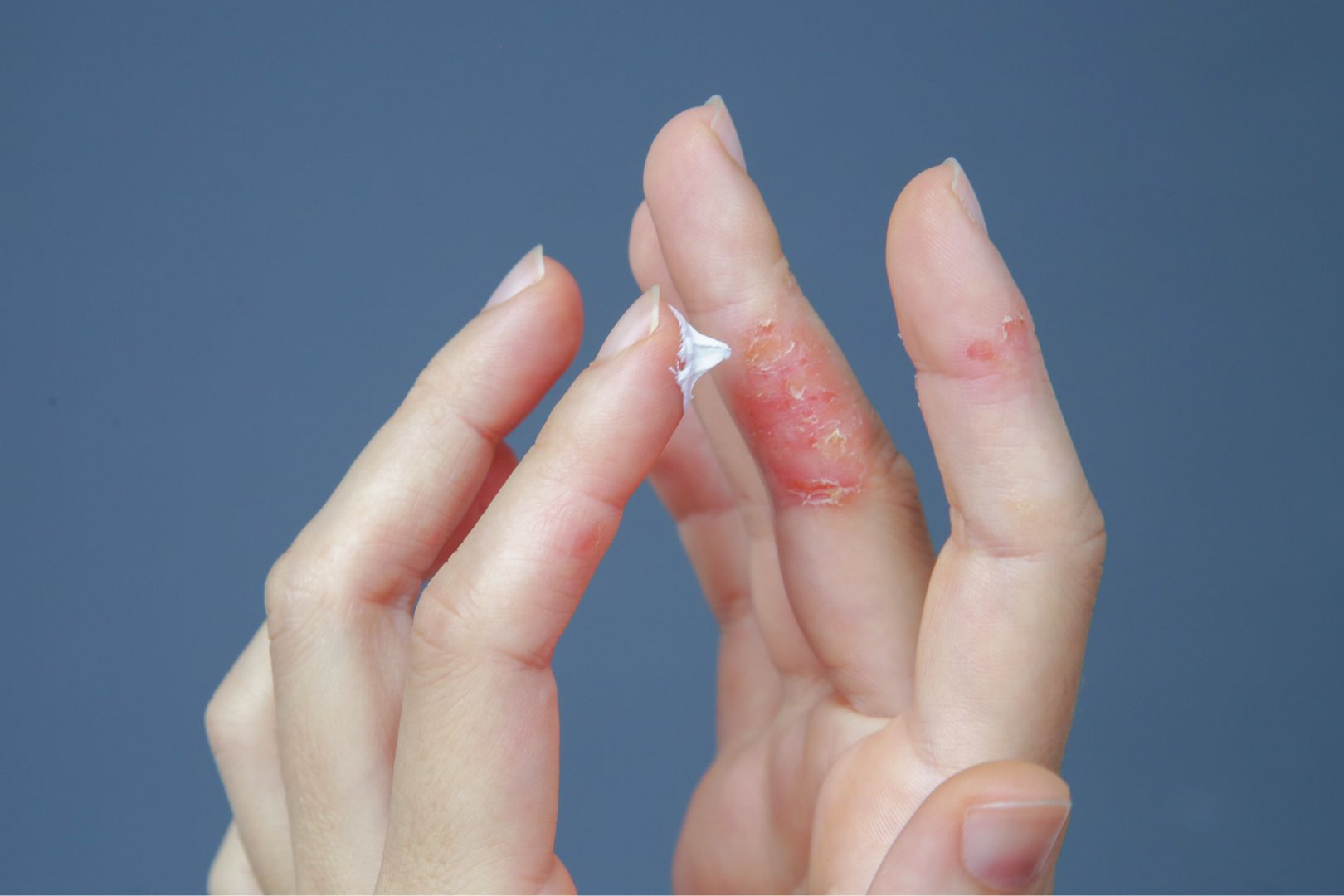 Psoriasis